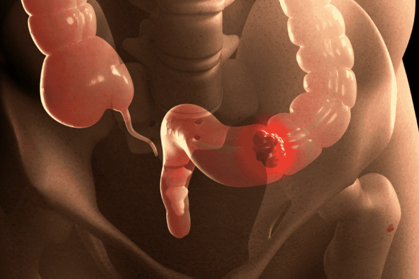 Nueva campa&ntilde;a de "Detecci&oacute;n Precoz de Cancer Colorrectal"